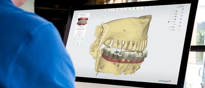 Digital implant treatment planning software showing a 3D surgical guide